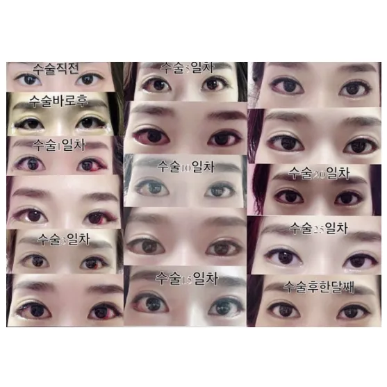 Lateral canthoplasty — Afternoon Plastic Surgery 1