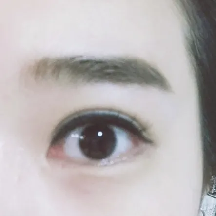 Lateral canthoplasty 2