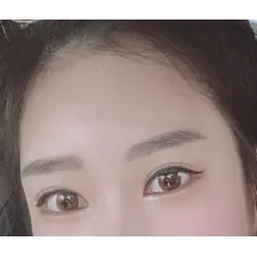 Lateral canthoplasty — Afternoon Plastic Surgery 3