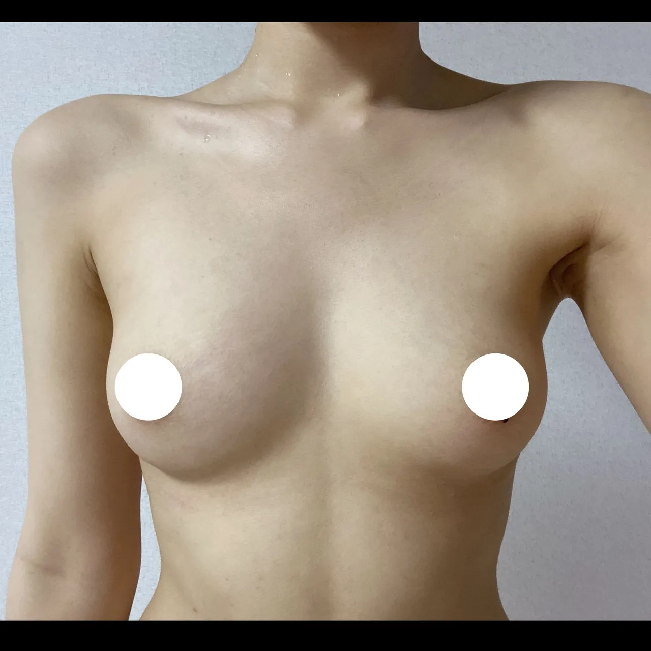Mentor Implant, Hybrid Fat Grafting — AMORATA PLASTIC SURGERY 1