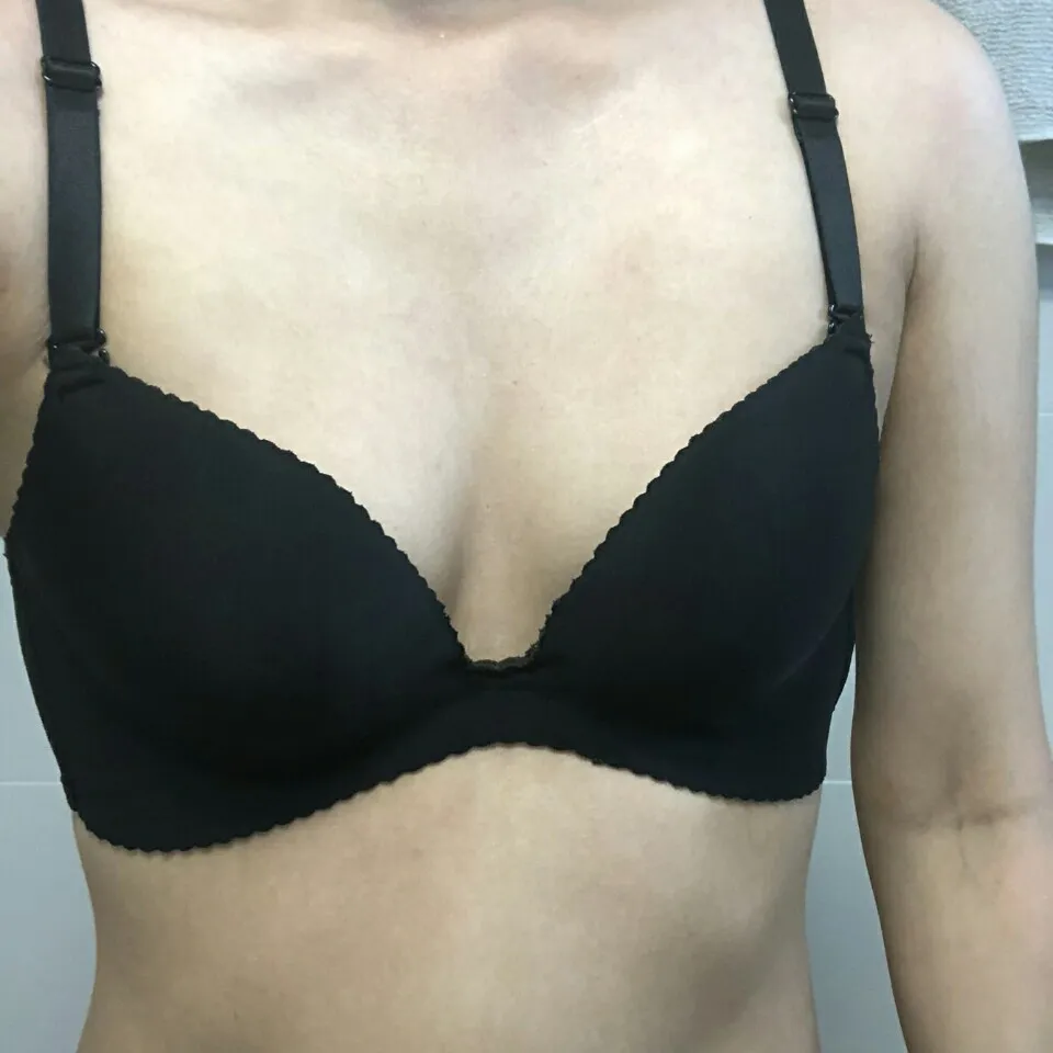 Motiva Implant 2
