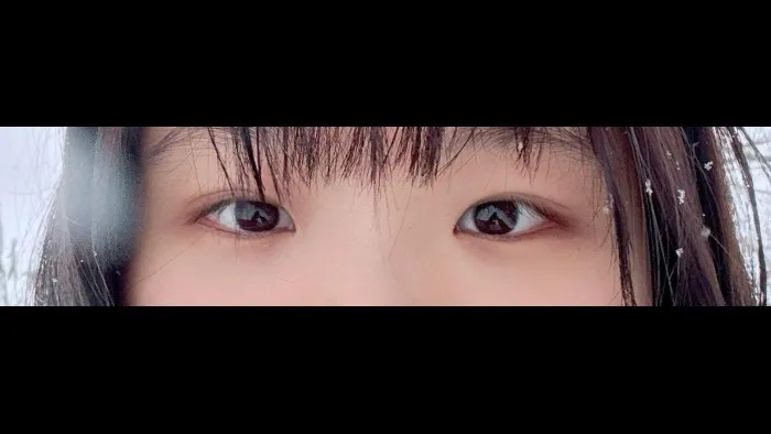 Partial Incision Double Eyelid Surgery, Ptosis Correction — RE&RE PLASTIC SURGERY 2