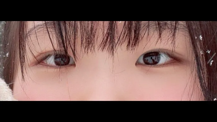Partial Incision Double Eyelid Surgery, Ptosis Correction — RE&RE PLASTIC SURGERY 3