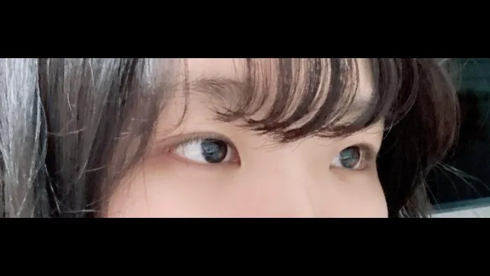 Partial Incision Double Eyelid Surgery, Ptosis Correction — RE&RE PLASTIC SURGERY 4