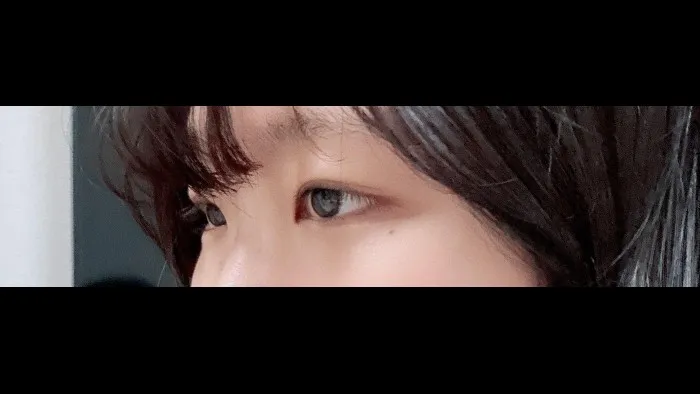 Partial Incision Double Eyelid Surgery, Ptosis Correction — RE&RE PLASTIC SURGERY 5