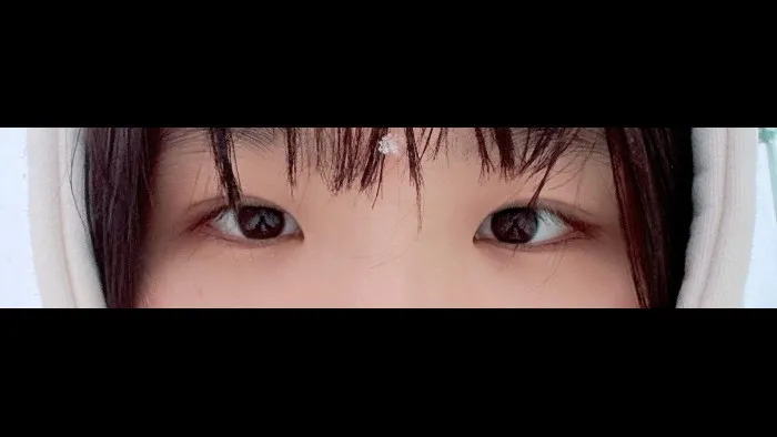 Partial Incision Double Eyelid Surgery, Ptosis Correction — RE&RE PLASTIC SURGERY 6