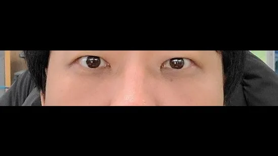 Lower Eyelid Fat Repositioning — RE&RE PLASTIC SURGERY 2