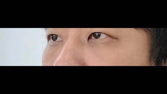 Lower Eyelid Fat Repositioning — RE&RE PLASTIC SURGERY 3