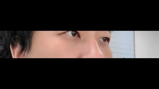 Lower Eyelid Fat Repositioning — RE&RE PLASTIC SURGERY 4