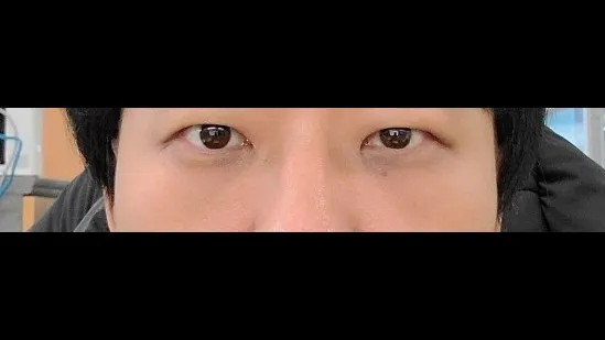 Lower Eyelid Fat Repositioning — RE&RE PLASTIC SURGERY 5