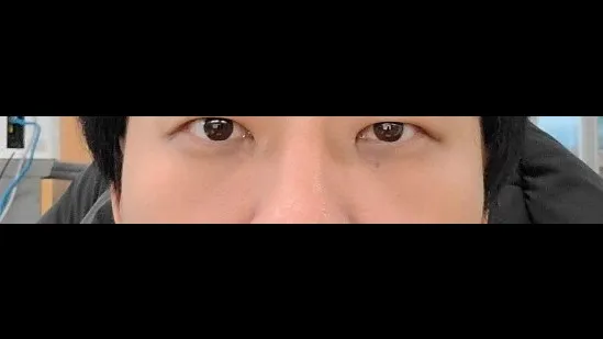 Lower Eyelid Fat Repositioning — RE&RE PLASTIC SURGERY 6