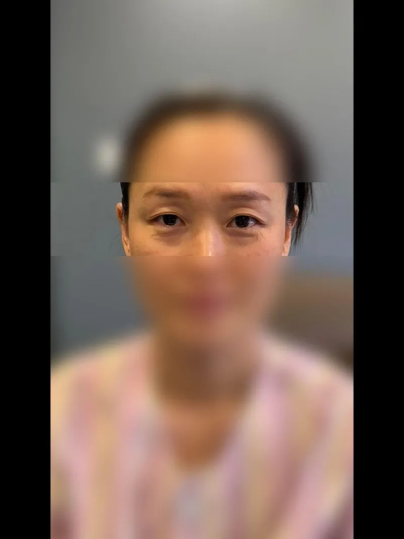 Sub-brow Lift, Lower Blepharoplasty (Aging Eye Rejuvenation), Ptosis Correction — RE&RE PLASTIC SURGERY 1