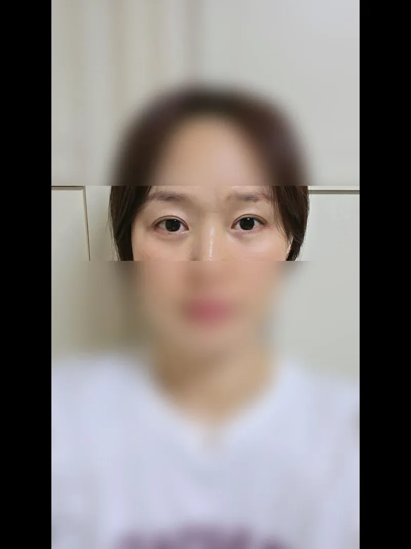 Sub-brow Lift, Lower Blepharoplasty (Aging Eye Rejuvenation), Ptosis Correction — RE&RE PLASTIC SURGERY 2