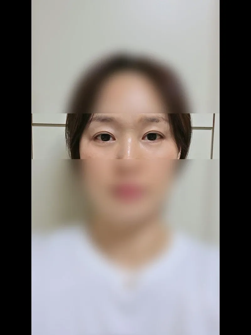 Sub-brow Lift, Lower Blepharoplasty (Aging Eye Rejuvenation), Ptosis Correction — RE&RE PLASTIC SURGERY 3