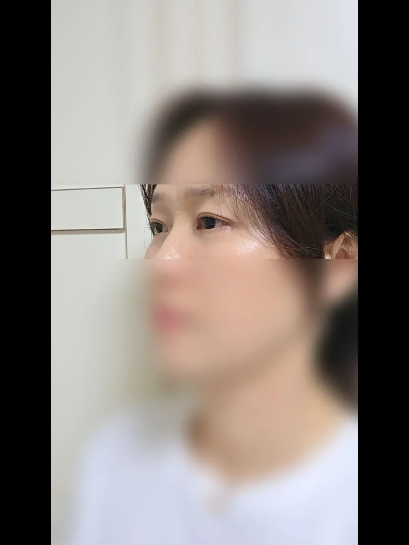Sub-brow Lift, Lower Blepharoplasty (Aging Eye Rejuvenation), Ptosis Correction — RE&RE PLASTIC SURGERY 4