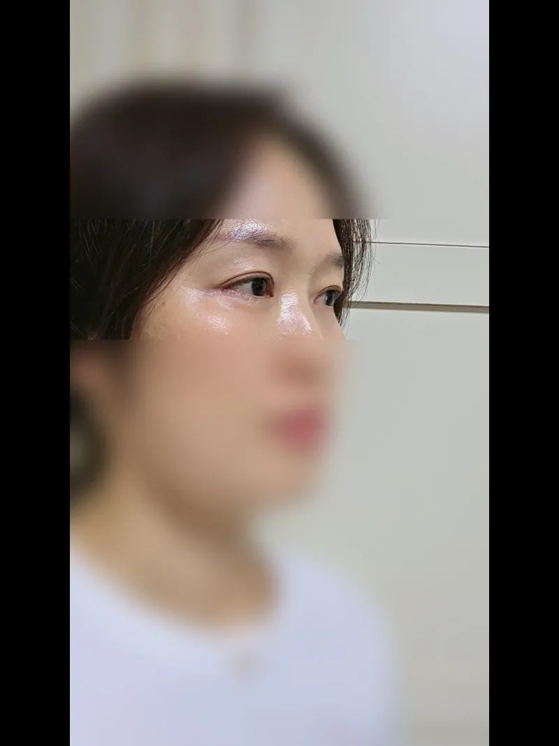 Sub-brow Lift, Lower Blepharoplasty (Aging Eye Rejuvenation), Ptosis Correction — RE&RE PLASTIC SURGERY 5