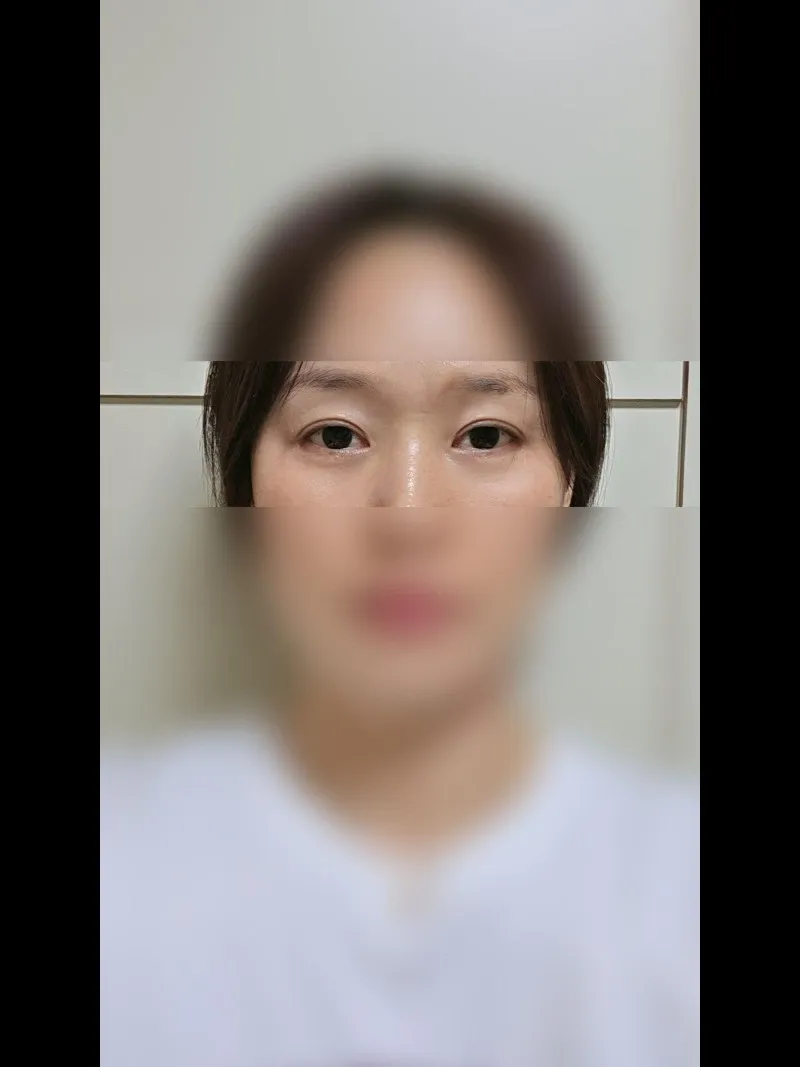 Sub-brow Lift, Lower Blepharoplasty (Aging Eye Rejuvenation), Ptosis Correction — RE&RE PLASTIC SURGERY 6