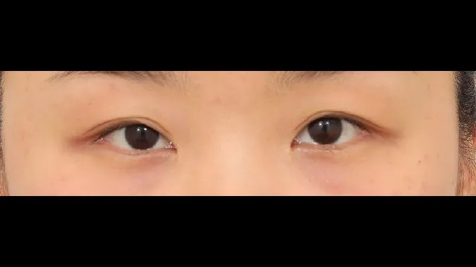 Revision ptosis correction, Epicanthoplasty Revision, Crease lowering, Incisional Double Eyelid Surgery, Ptosis Correction 1
