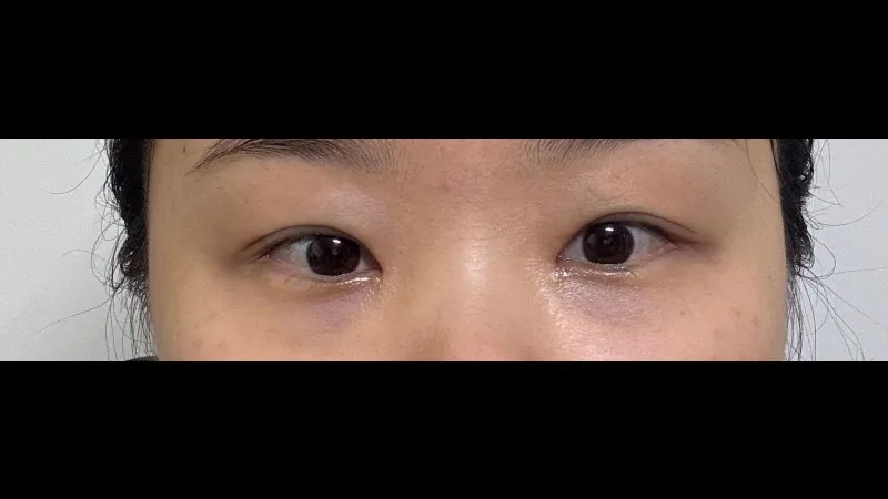 Revision ptosis correction, Epicanthoplasty Revision, Crease lowering, Incisional Double Eyelid Surgery, Ptosis Correction — RE&RE PLASTIC SURGERY 2