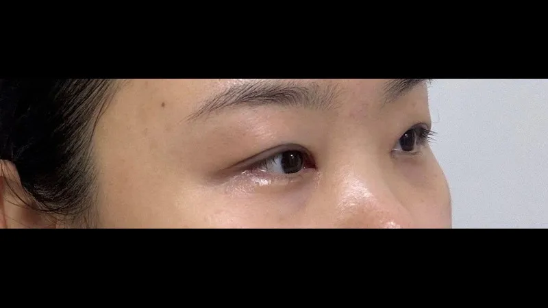 Revision ptosis correction, Epicanthoplasty Revision, Crease lowering, Incisional Double Eyelid Surgery, Ptosis Correction — RE&RE PLASTIC SURGERY 3