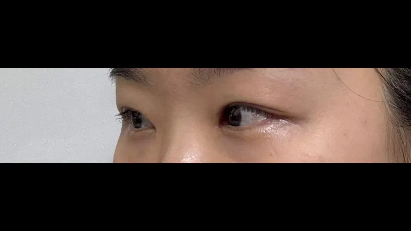Revision ptosis correction, Epicanthoplasty Revision, Crease lowering, Incisional Double Eyelid Surgery, Ptosis Correction — RE&RE PLASTIC SURGERY 4