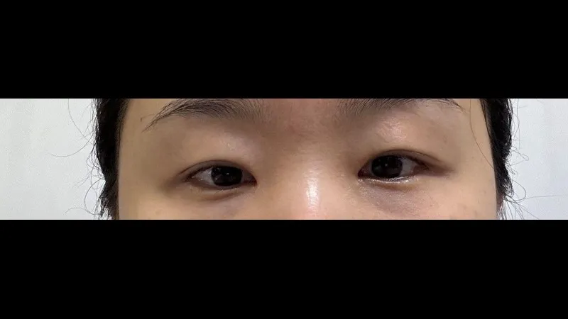 Revision ptosis correction, Epicanthoplasty Revision, Crease lowering, Incisional Double Eyelid Surgery, Ptosis Correction — RE&RE PLASTIC SURGERY 5