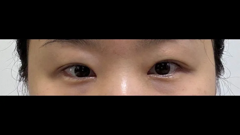 Revision ptosis correction, Epicanthoplasty Revision, Crease lowering, Incisional Double Eyelid Surgery, Ptosis Correction — RE&RE PLASTIC SURGERY 6