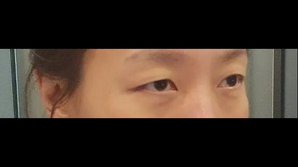 Sub-brow Lift — RE&RE PLASTIC SURGERY 2