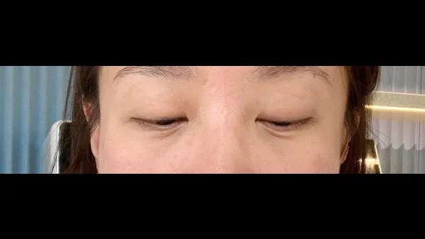 Sub-brow Lift — RE&RE PLASTIC SURGERY 3