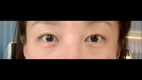 Sub-brow Lift — RE&RE PLASTIC SURGERY 4