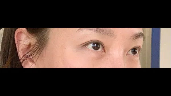 Sub-brow Lift — RE&RE PLASTIC SURGERY 5