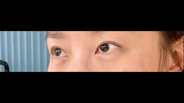 Sub-brow Lift — RE&RE PLASTIC SURGERY 6