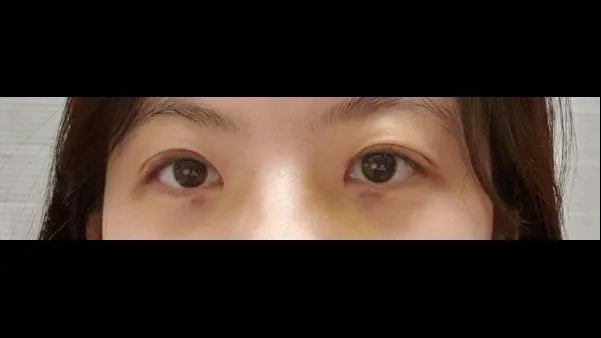 Natural Adhesion Double Eyelid Surgery, Ptosis Correction — RE&RE PLASTIC SURGERY 2