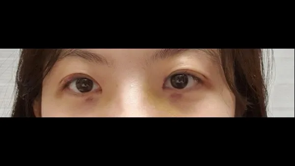 Natural Adhesion Double Eyelid Surgery, Ptosis Correction — RE&RE PLASTIC SURGERY 3