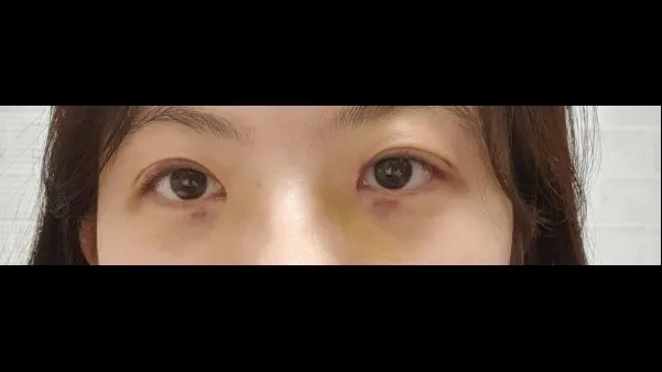 Natural Adhesion Double Eyelid Surgery, Ptosis Correction — RE&RE PLASTIC SURGERY 4