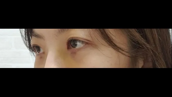 Natural Adhesion Double Eyelid Surgery, Ptosis Correction — RE&RE PLASTIC SURGERY 5