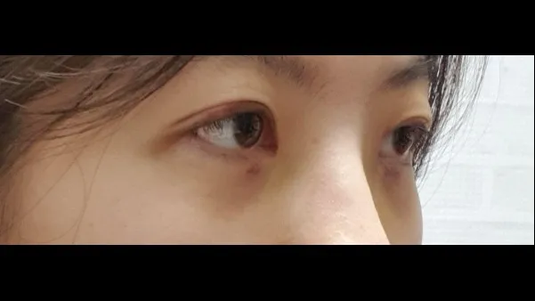 Natural Adhesion Double Eyelid Surgery, Ptosis Correction — RE&RE PLASTIC SURGERY 6