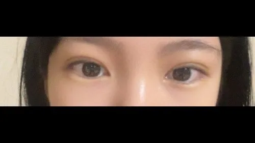 Natural Adhesion Double Eyelid Surgery, Ptosis Correction — RE&RE PLASTIC SURGERY 2