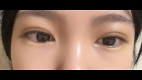 Natural Adhesion Double Eyelid Surgery, Ptosis Correction — RE&RE PLASTIC SURGERY 3