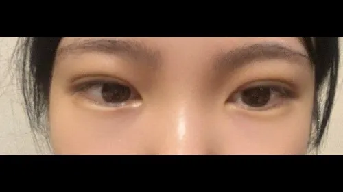 Natural Adhesion Double Eyelid Surgery, Ptosis Correction — RE&RE PLASTIC SURGERY 4