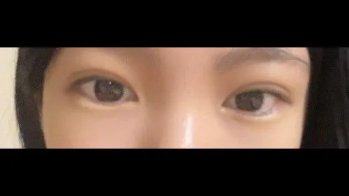 Natural Adhesion Double Eyelid Surgery, Ptosis Correction — RE&RE PLASTIC SURGERY 5