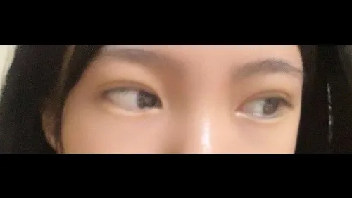 Natural Adhesion Double Eyelid Surgery, Ptosis Correction — RE&RE PLASTIC SURGERY 6