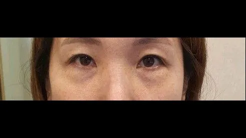 Incisional Double Eyelid Surgery, Lower Eyelid Fat Grafting, Lower Blepharoplasty (Aging Eye Rejuvenation) — RE&RE PLASTIC SURGERY 1