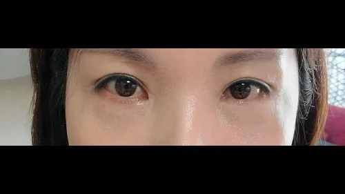 Incisional Double Eyelid Surgery, Lower Eyelid Fat Grafting, Lower Blepharoplasty (Aging Eye Rejuvenation) — RE&RE PLASTIC SURGERY 2