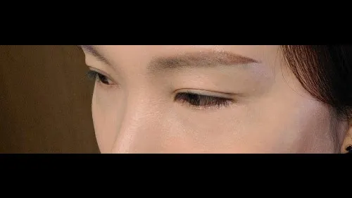 Incisional Double Eyelid Surgery, Lower Eyelid Fat Grafting, Lower Blepharoplasty (Aging Eye Rejuvenation) — RE&RE PLASTIC SURGERY 3