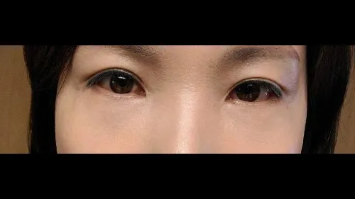 Incisional Double Eyelid Surgery, Lower Eyelid Fat Grafting, Lower Blepharoplasty (Aging Eye Rejuvenation) — RE&RE PLASTIC SURGERY 4