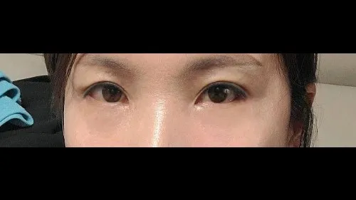 Incisional Double Eyelid Surgery, Lower Eyelid Fat Grafting, Lower Blepharoplasty (Aging Eye Rejuvenation) — RE&RE PLASTIC SURGERY 5
