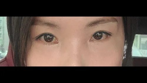 Incisional Double Eyelid Surgery, Lower Eyelid Fat Grafting, Lower Blepharoplasty (Aging Eye Rejuvenation) — RE&RE PLASTIC SURGERY 6