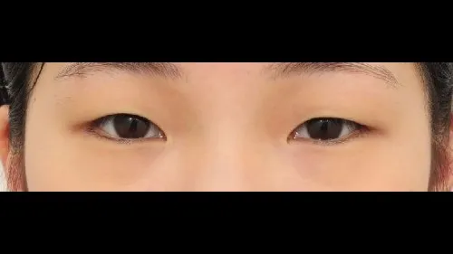 Incisional Double Eyelid Surgery, Ptosis Correction — RE&RE PLASTIC SURGERY 1