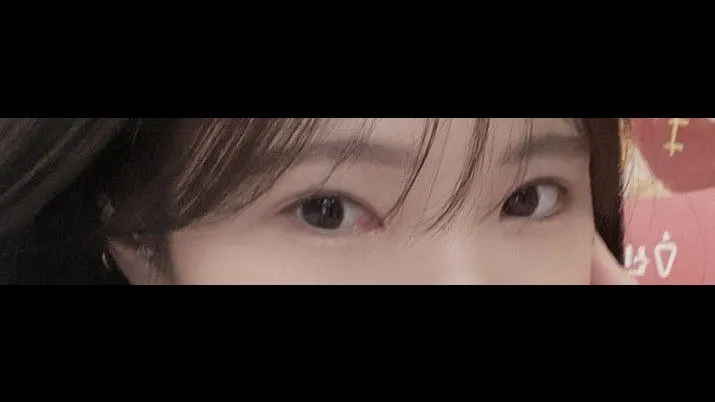 Incisional Double Eyelid Surgery, Ptosis Correction — RE&RE PLASTIC SURGERY 2